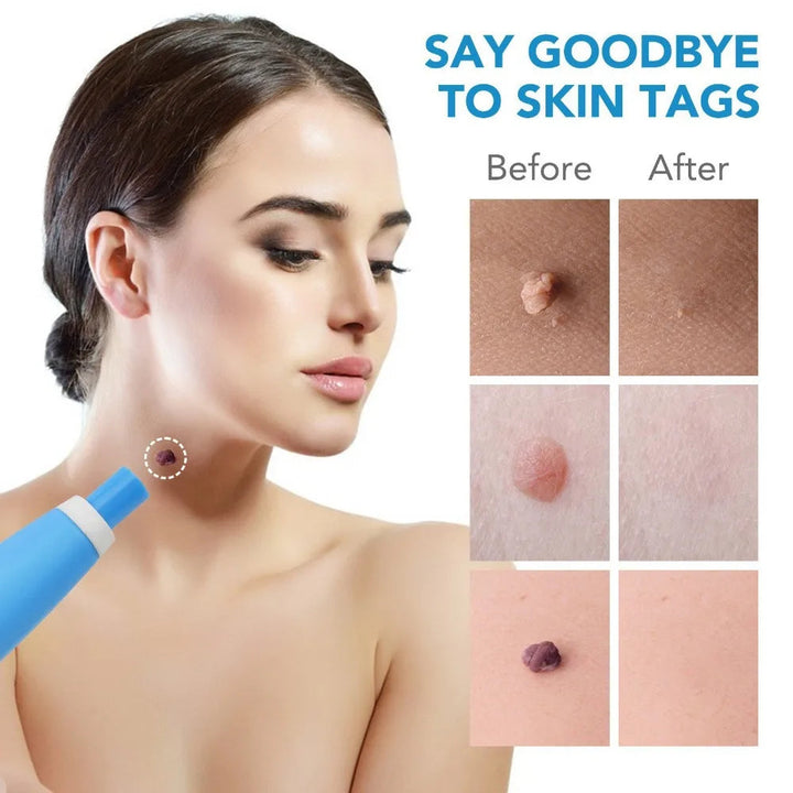 Auto Skin Tag Removal Kit